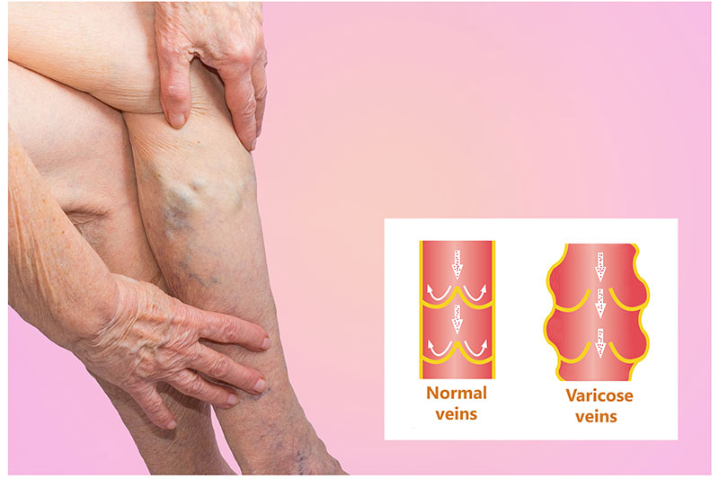 Recognize Deep Vein Thrombosis In Your Leg On Time By These 5 Symptoms
