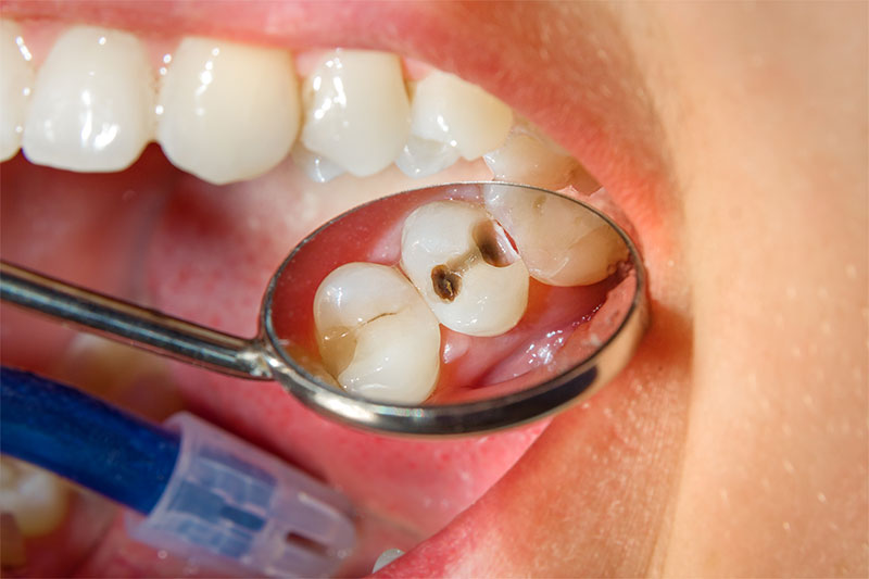 4 Complications That Can Arise If You Ignore A Cavity