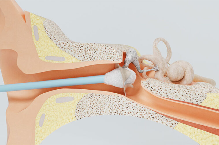 Three Reasons Why You Should Stop Using Cotton Swabs World Wise News