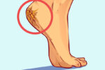 Why You May Get Cracked Heels and How to Fix Them Naturally
