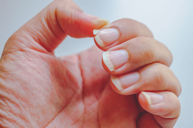 What Your Fingernail Lines Say About Your Health World Wise News