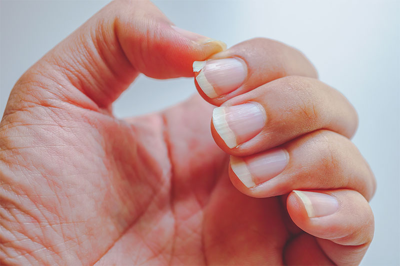 Here's What It Means If You Have Ridges on Your Nails