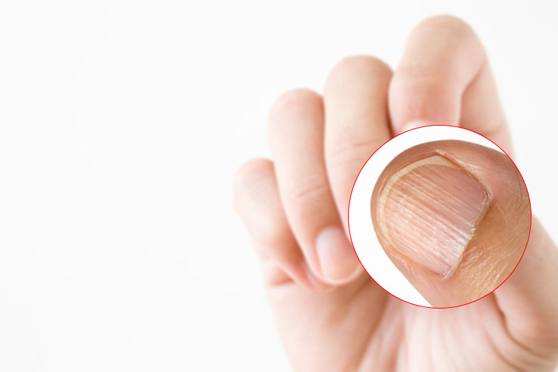 Here's What It Means If You Have Ridges on Your Nails