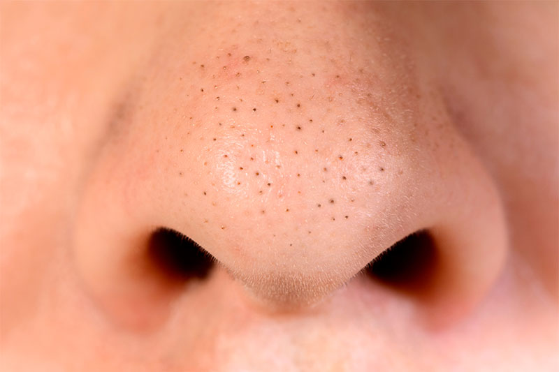 The Surprising All-Natural Ingredient You Need to Get Rid of Blackheads