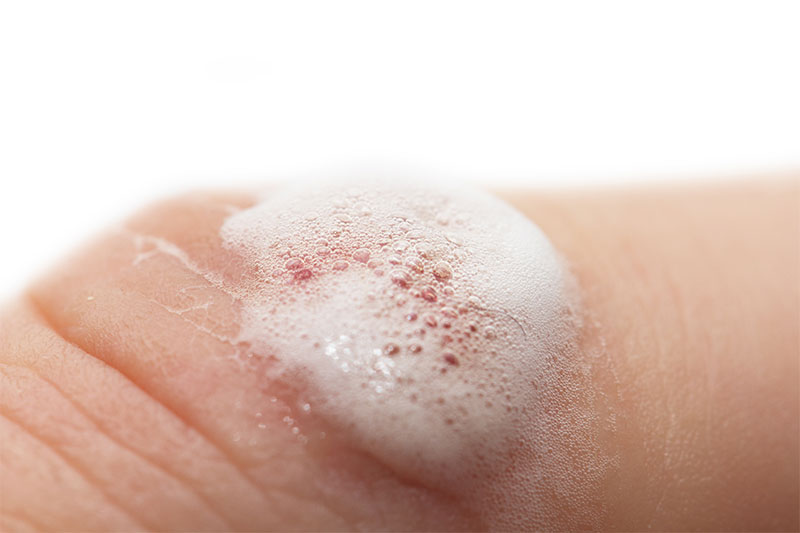 How Can Hydrogen Peroxide Damage Skin?