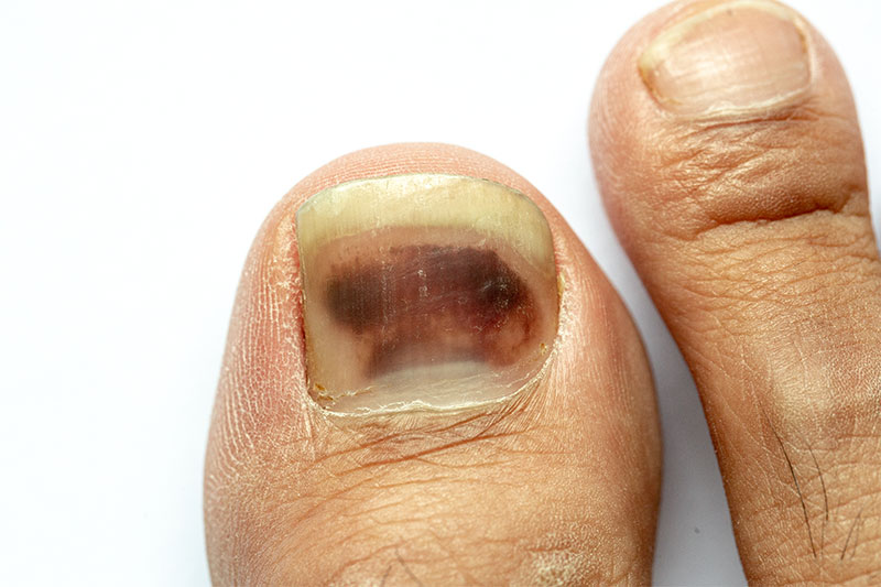 This Specific Fingernail Mark Could Be A Melanoma Symptom – World Wise News