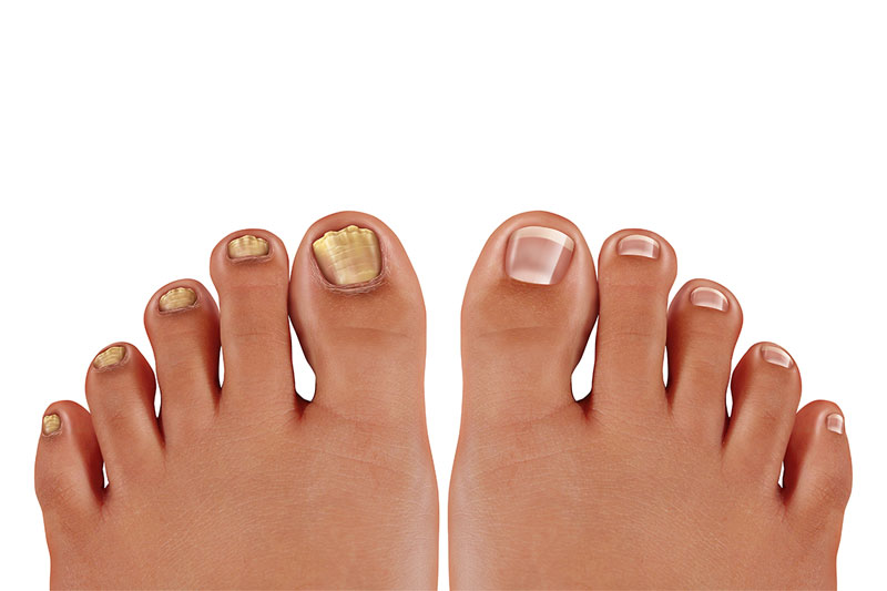 Fungal Infections In Your Nails