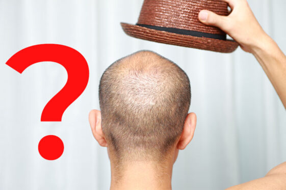 Is It Possible For Hats To Cause Hair Loss? – World Wise News