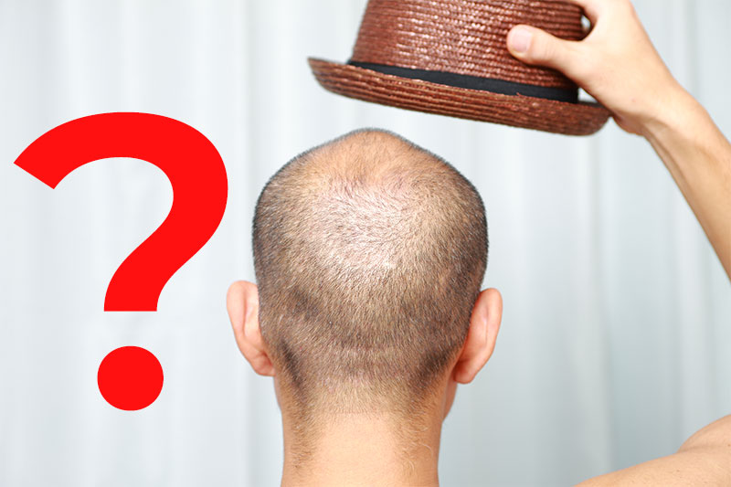 Is It Possible For Hats To Cause Hair Loss?