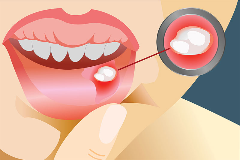 Here Is The Secret To Getting Rid Of Canker Sores