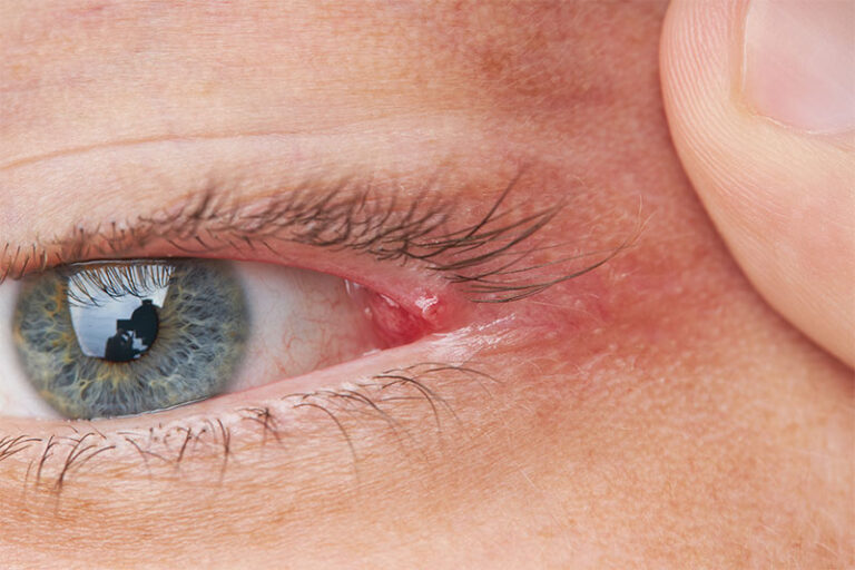 Why Your Eyes Get Crusty When You Sleep World Wise News