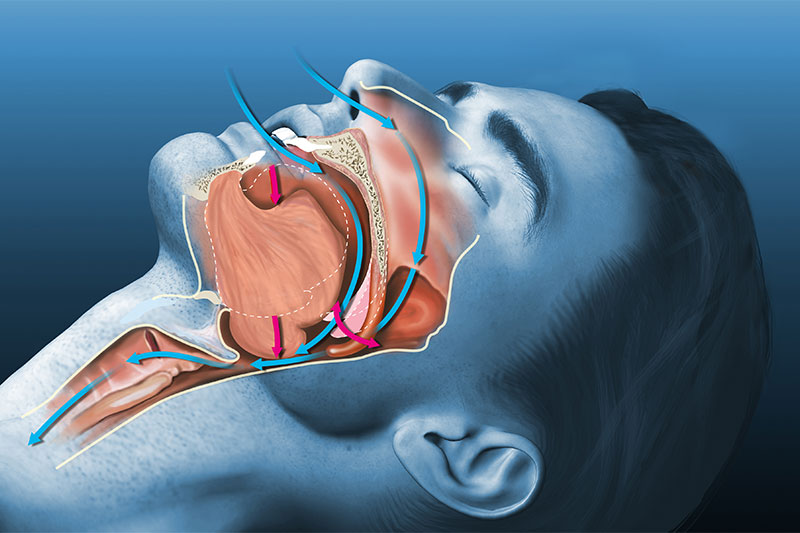 Hugging Something As You Sleep Helps Reduce Snoring And Sleep Apnea