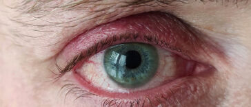 Fell Asleep Without Removing Your Lenses? This Can Happen To Your Eyes