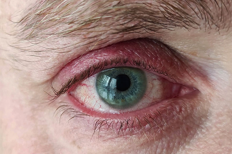 Fell Asleep Without Removing Your Lenses? This Can Happen To Your Eyes