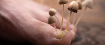 12 Signs Fungus Might Be Taking Over Your Body