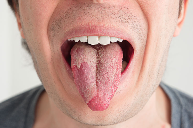 This Is What A White Tongue Says About Your Health! Very Few People Know This!