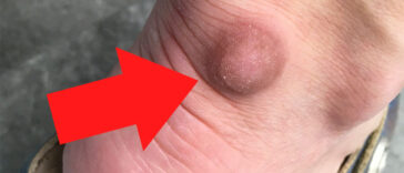 Do You Have Bumps in Your Feet? Get a Blood Test