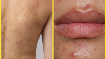 This is what your acne is saying about your life style