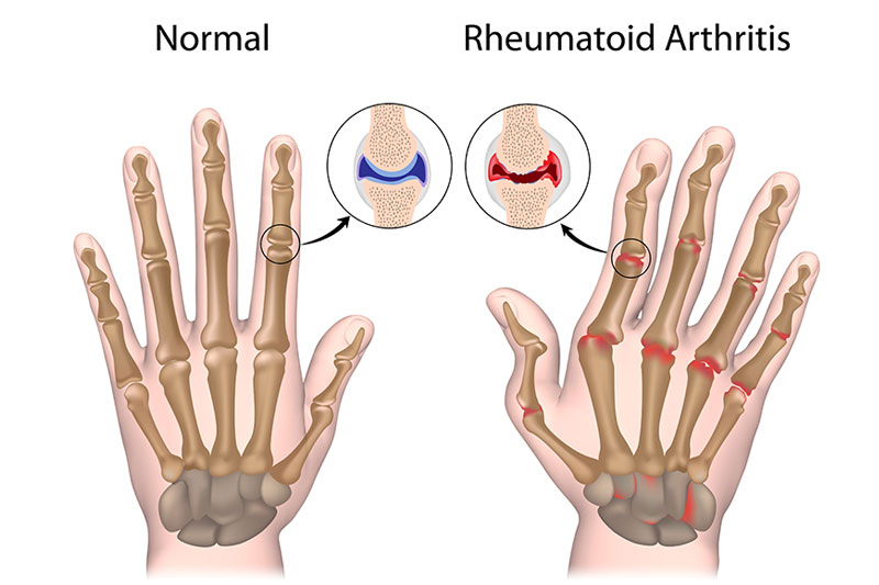 How Are Rheumatoid Arthritis And Psoriatic Arthritis Different?