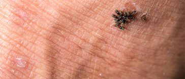 Botflies: The Unwanted Guests Living In Your Body