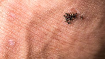 Botflies: The Unwanted Guests Living In Your Body