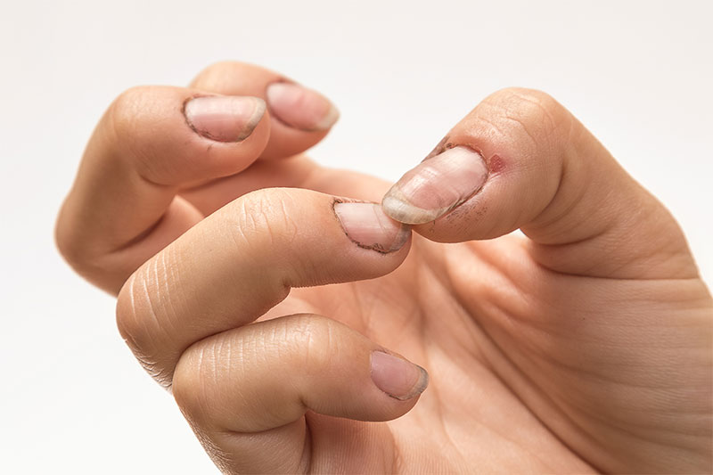 What Is Lurking Underneath Your Dirty Fingernails?