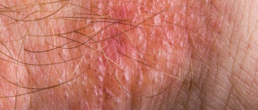 These Are The Most Common Summer Health Problems