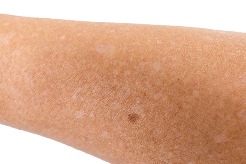 The Truth About Those White Freckles On Your Arms Idiopathic Guttae Hypomelanosis
