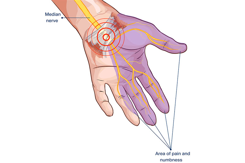 Why Does Carpal Tunnel Syndrome Cause Tingling And Pain?