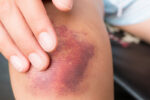 Why do some people bruise easily and when do you need to worry about it? An expert explains