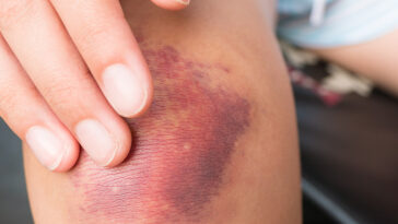 Why do some people bruise easily and when do you need to worry about it? An expert explains